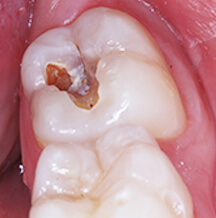 Cavity Teeth Near Me